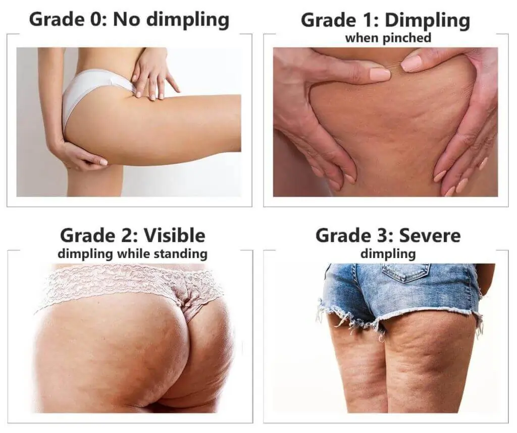 Representation of the stages of cellulite development Dartford